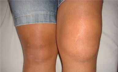 Die Ursachen der Arthrose des Kniegelenks