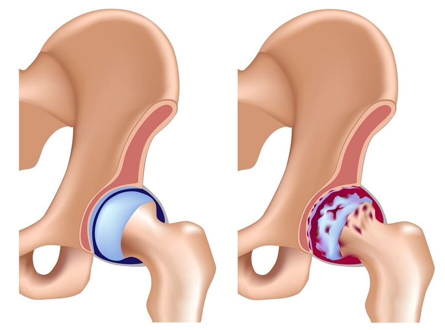 gesundes Gelenk und Arthrose des Hüftgelenks